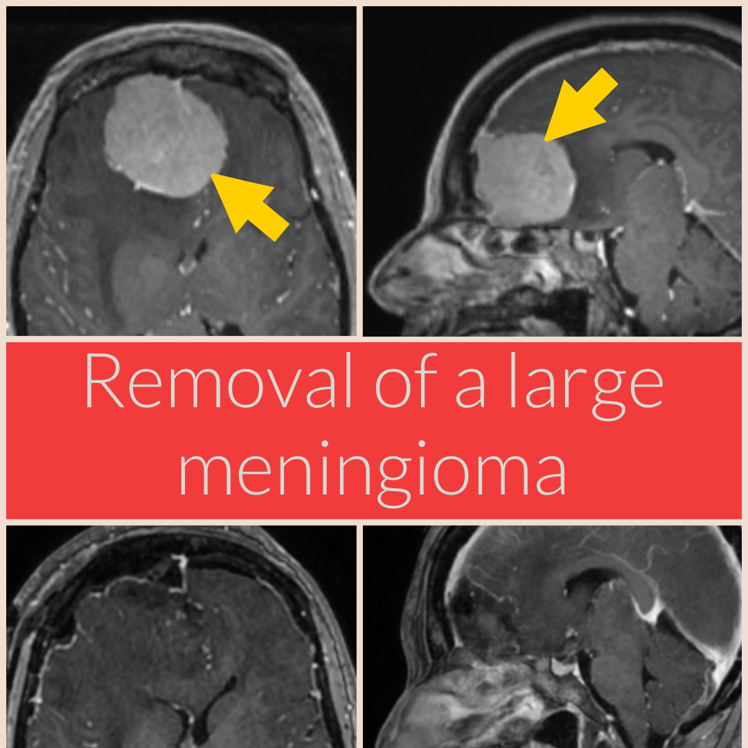 Meningioma — Matthew Mian, MD
